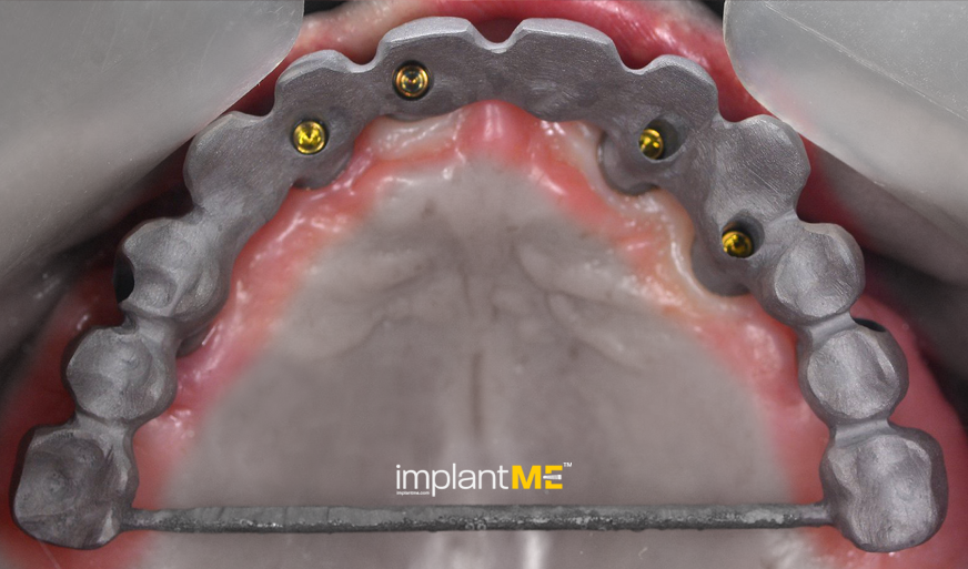 implantME_2